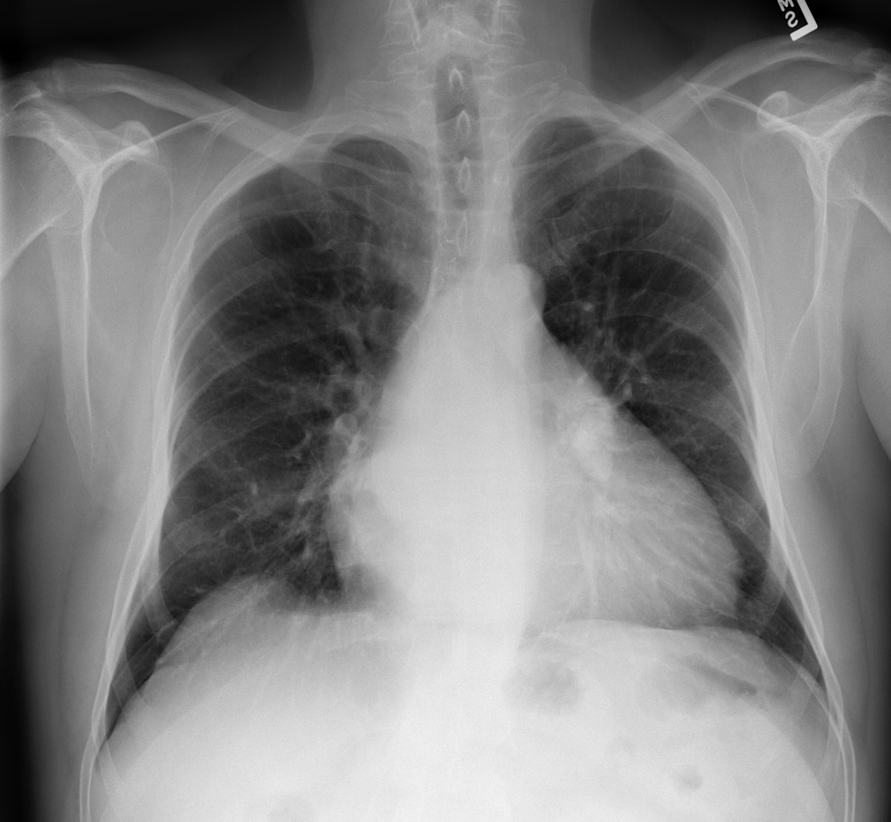 A PA chest radiograph with an enlarged cardiac silhouette and upper-zone vascular congestion, used to demonstrate a cardiothoracic ratio above 0.5.