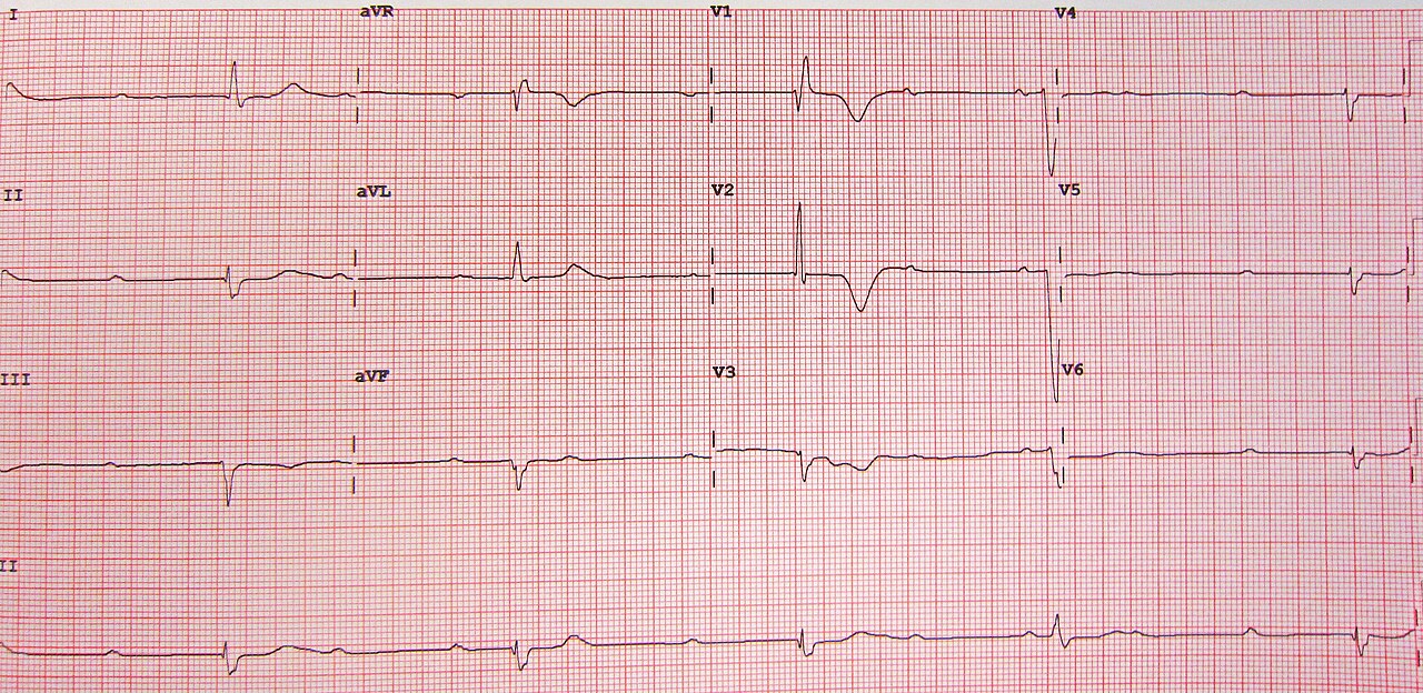Clinical 12-lead ECG photograph with a lead II rhythm strip.