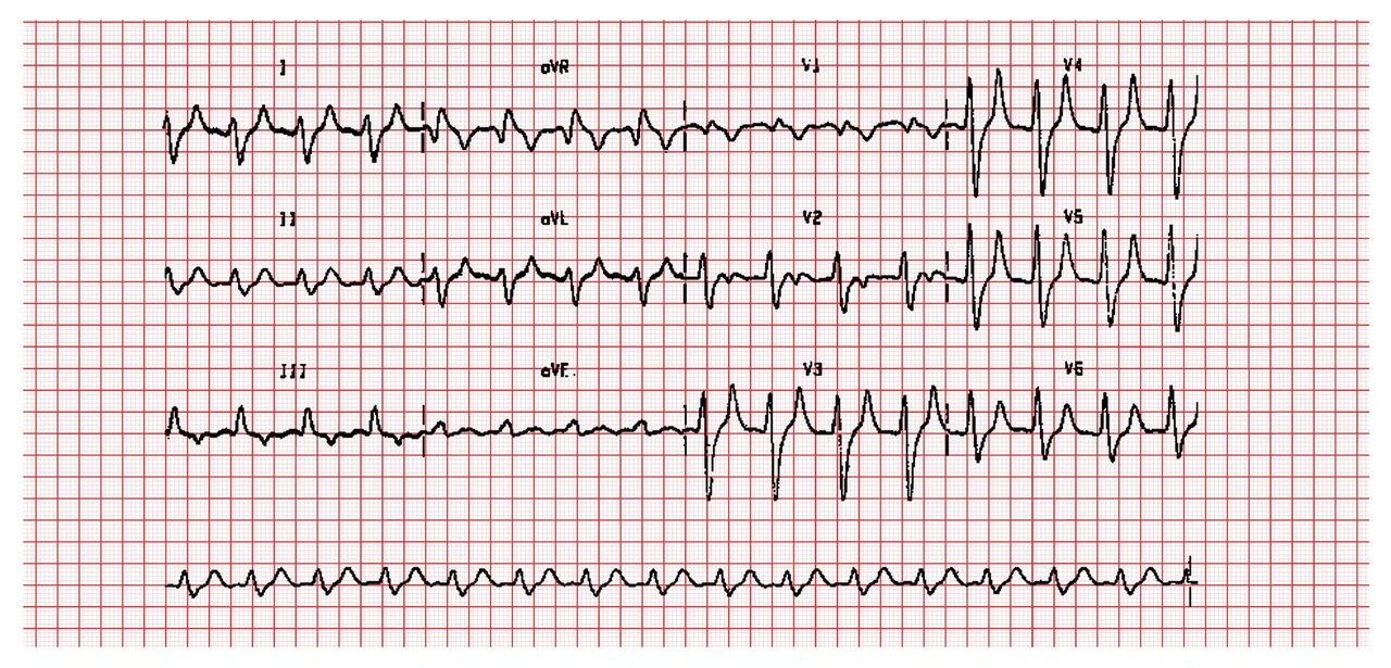 A 12-lead ECG on red grid paper. The T waves are tall, narrow and symmetrically peaked, the QRS complexes are broad, and the bottom rhythm strip shows a slow, broad, sinusoidal wave.
