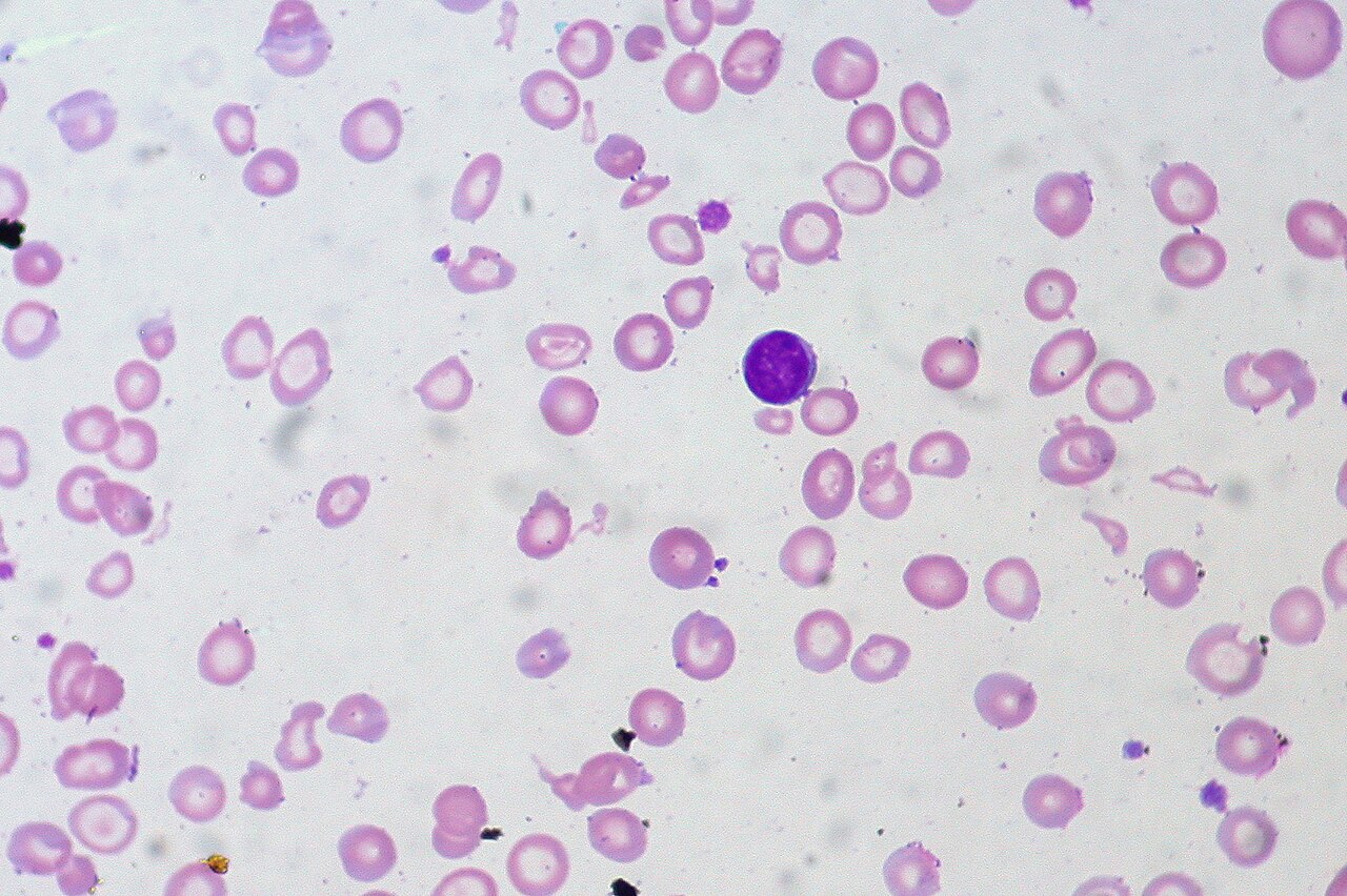 Microscope photograph of a peripheral blood film for interpretation.